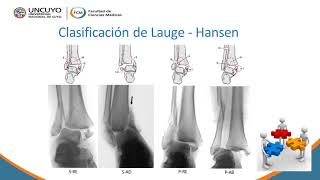 Fracturas de tobillo [upl. by Sopher]