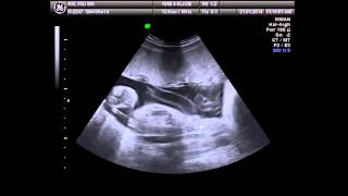 Pregnancy 8 months baby ultrasound [upl. by Zeke706]