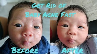 How to Get Rid of Baby Acne Fast [upl. by Kooima716]