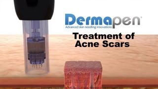 MicroNeedling for Acne Scars  Dermapen® Treatment [upl. by Arihaj]