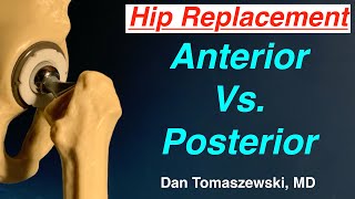 Anterior Vs Posterior Hip Replacement [upl. by Acsirp723]