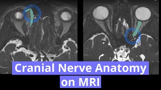 Vestibular Neuritis Recovery 1 year update [upl. by Mehsah227]