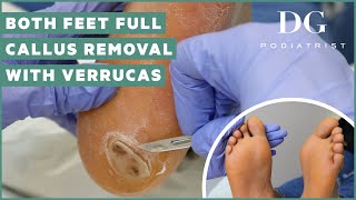 Callus removal from feet both feet and three verruca plantar warts treatment [upl. by Cordey488]