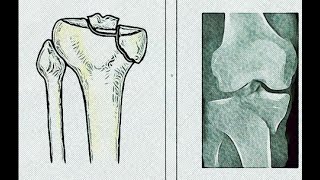 Posteromedial Approach to the Proximal Tibia [upl. by Hgielah]