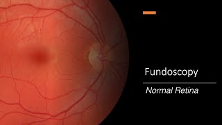 Healthy Retina Fundoscopy [upl. by Zehcnas]