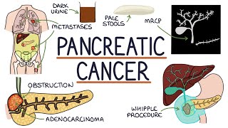 Understanding Pancreatic Cancer [upl. by Leupold]