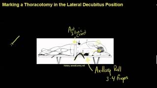 Positioning and marking a thoracotomymp4 [upl. by Iraam417]