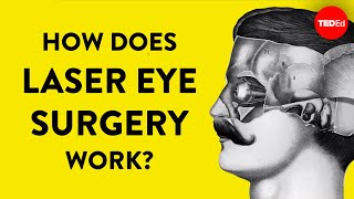 How does laser eye surgery work  Dan Reinstein [upl. by Annoyek851]