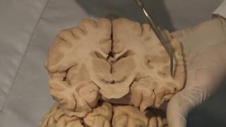 Cortical Localization Neuroanatomy Video Lab  Brain Dissections [upl. by Yesoj]