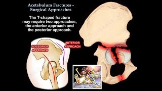 Acetabulum Fractures Surgical Approaches  Everything You Need To Know  Dr Nabil Ebraheim [upl. by Dorri]