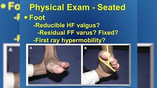 Dr Evan Loewy Posterior Tibial Tendon Dysfunction  Florida Orthopaedic Institute [upl. by Ydne935]