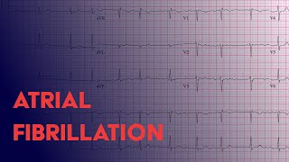 Atrial Fibrillation Afib  EKG ECG Interpretation [upl. by Adiela]