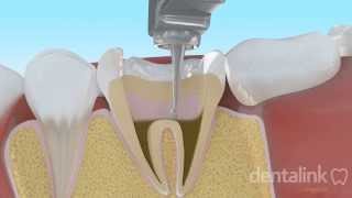 Endodoncia completa PASO A PASO  Video 3D [upl. by Edgell]