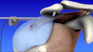 Shoulder Arthroscopy [upl. by Aicnarf226]