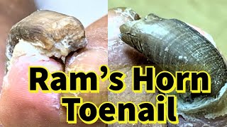 Rams Horn Toenail Severe Fungal Toenail [upl. by Suoinuj721]