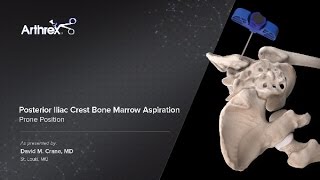 Posterior Iliac Crest Bone Marrow Aspiration  Prone Position [upl. by Bearnard]