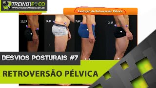 Retroversão Pélvica  Equilíbrio Pélvico  Desvios Posturais 7 [upl. by Aire370]