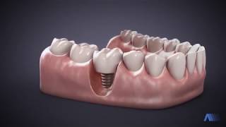 ▷ Vídeo Odontología 3D  GrupoAudiovisualcom [upl. by Ermentrude]