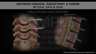 Anterior Cervical Discectomy amp Fusion at C34 C45 amp C56 [upl. by Allebasi]