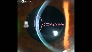 Slit Lamp Techniques Optic Section and Parallepiped [upl. by Helsell]